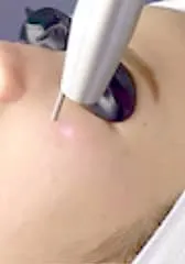 レーザートーニング