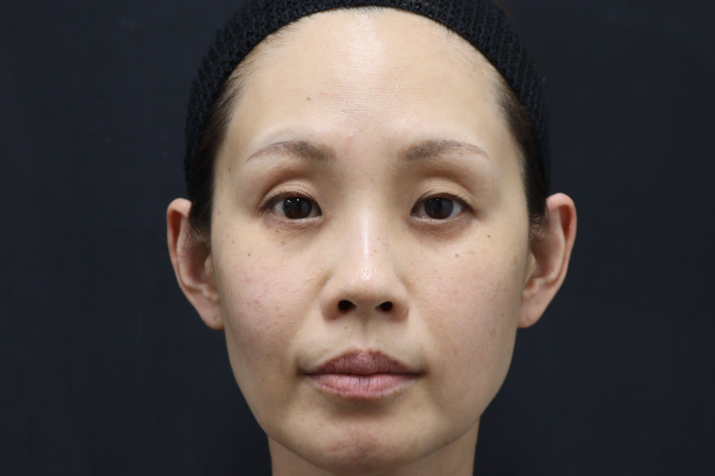 鼻スレッド 症例写真 before