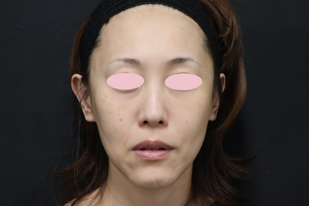 ヒアルロン酸 before