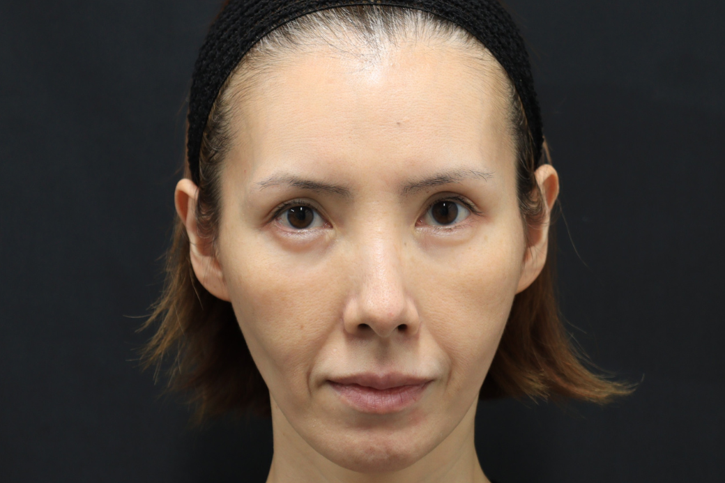 ヒアルロン酸　before