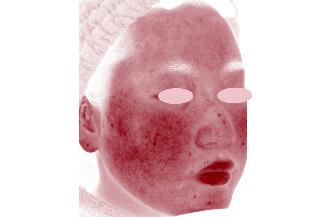 ノーリス症例写真　before