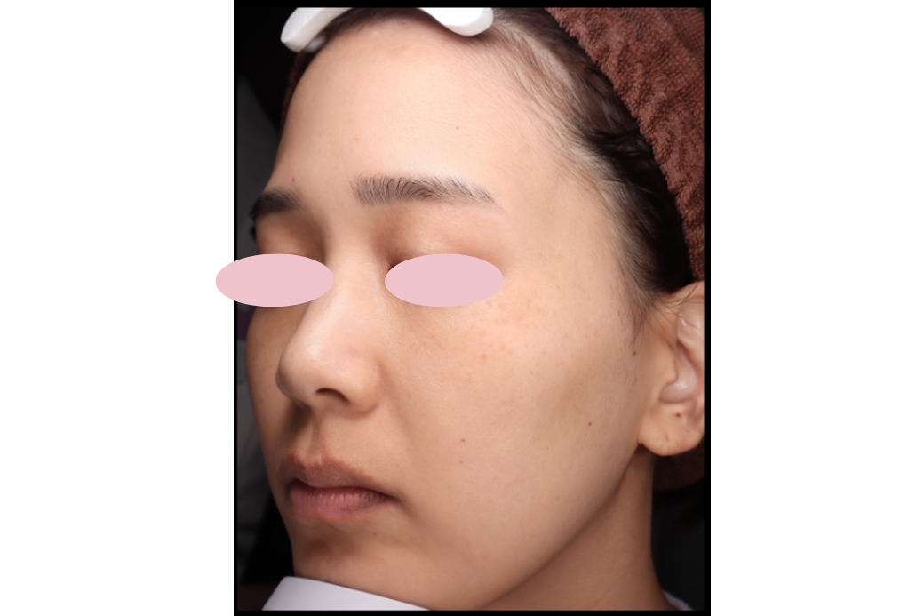15 RF症例写真 before
