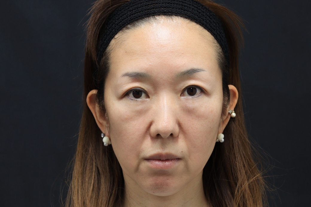 HY 症例写真　before