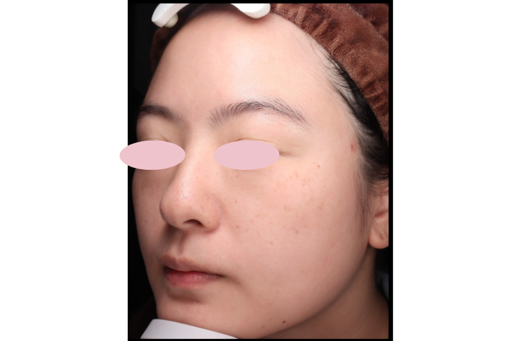 11 RF症例写真 before