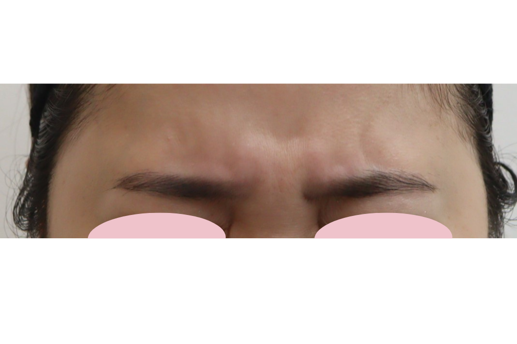 botox 症例写真 目　before