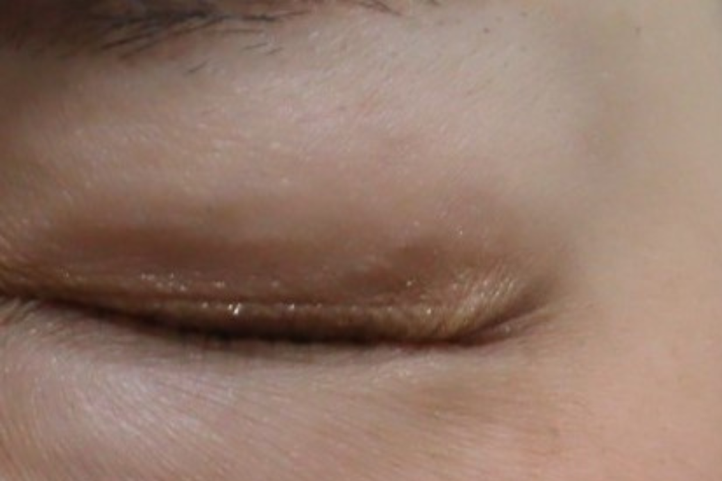 目尻 botox after