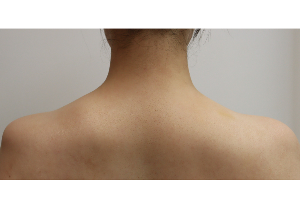 ボトックス　症例 before 肩