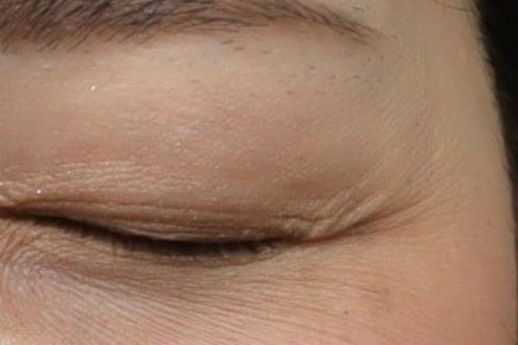 目尻 botox before