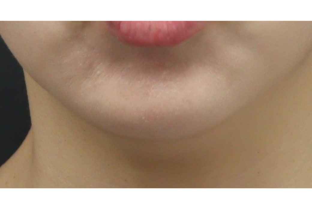 ボトックス after