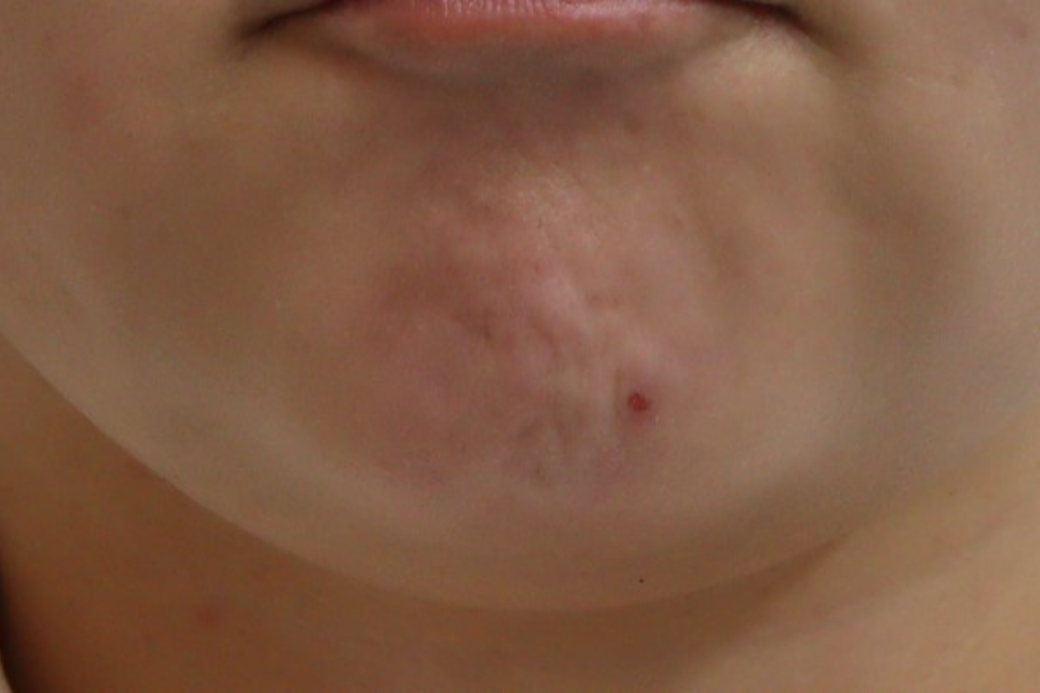 botox 症例写真 顎　before
