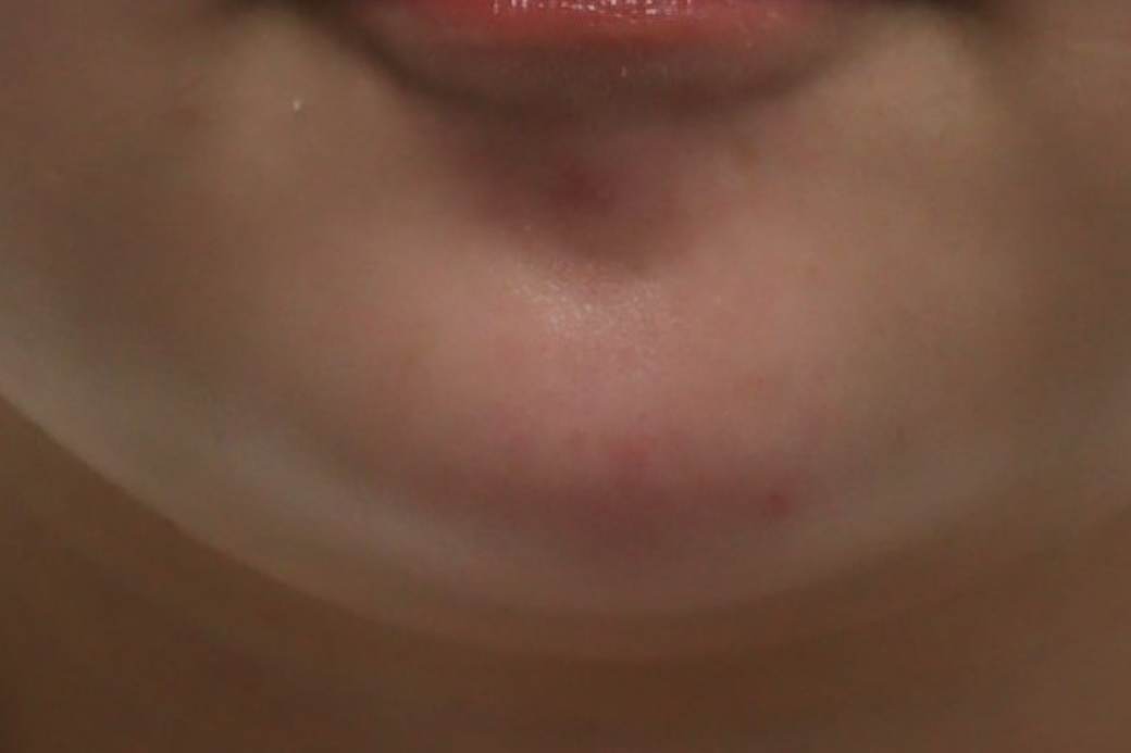 botox 症例写真 顎　after