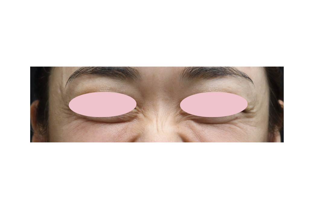 botox 目尻 before　1