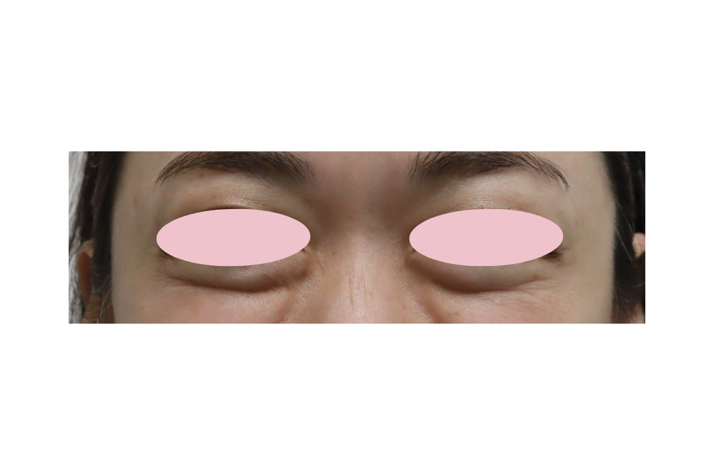 botox 目尻 after　1