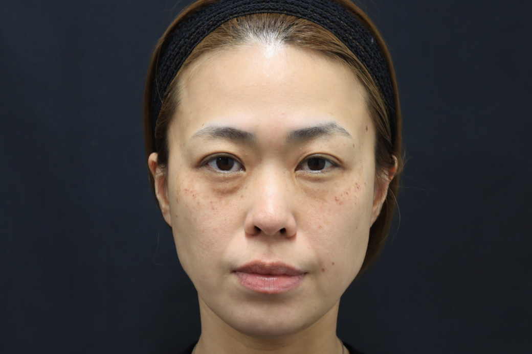 ヒアルロン酸　こめかみ・目の下　before 全顔